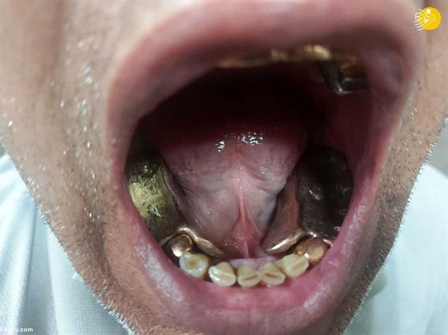 قاچاق طلا به روش عجیب+ عکس