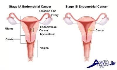 علائم و پیشگیری از سرطان رحم