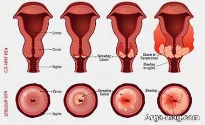 نشانه های سرطان رحم