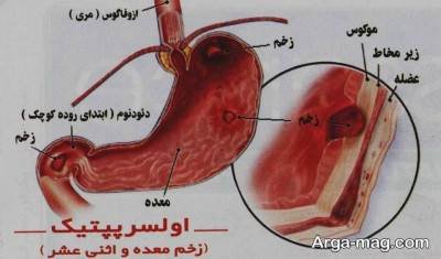 چگونه زخم معده را در خانه درمان کنیم؟