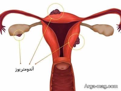 بهبود اندومتریوز با مصرف گیاه پنج انگشت