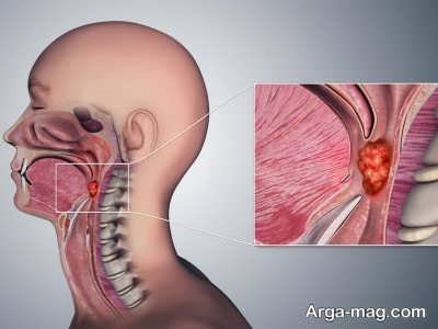 راهکار های ایده ال برای درمان سوختگی گلو