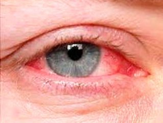 6 عفونت چشمی که می‌توانند عواقب خطرناکی داشته باشند