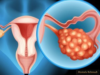 نشانه اصلی ابتلا به سرطان تخمدان