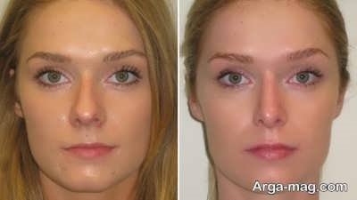 قبل و بعد از جراحی بینی