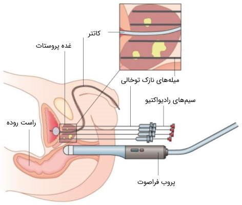 براکی‌تراپی؛ راهی برای درمان سرطان پروستات