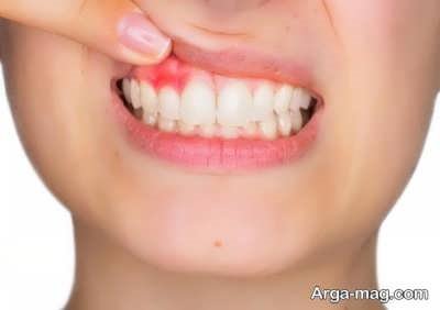 بهره بردن از درمان خانگی جهت رفع عفونت دندان