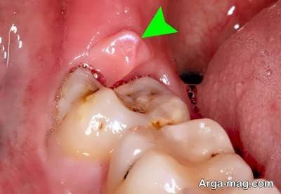 روش های مختلف رفع عفونت دندان