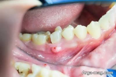 رفع عفونت دندان با روش های خانگی