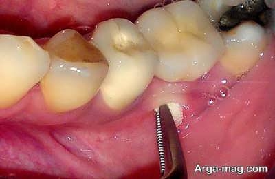 استفاده از روش های خانگی جهت بهبود عفونت دندان