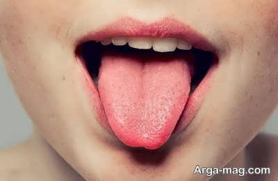 درمان های دارویی جوش زبان 