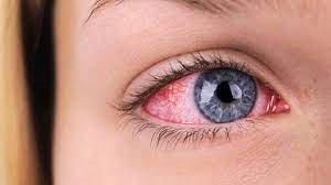 5 علت رایج قرمزی چشم و راه‌های درمان آن