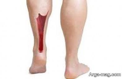 درد در ناحیه ساق پا