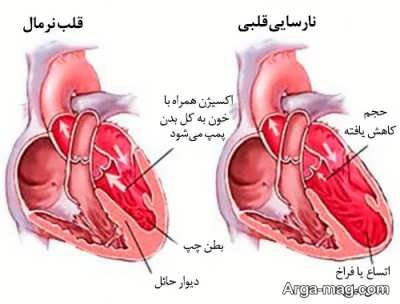 درمان نارسایی قلبی با چه روش هایی انجام می شود؟