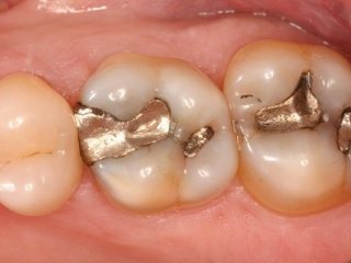 این عادت‌های شایع باعث پوسیدگی دندان می‌شود!