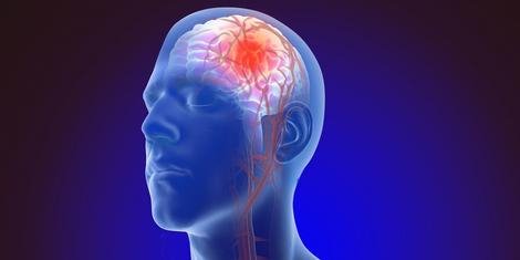 آنوریسم مغزی چیست و احتمال ابتلا به آن چقدر است؟(عصرایران)