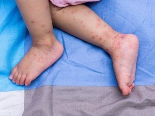 جزئیاتی درباره شیوع بیماری دست و پا و دهان ؛ کودکان اصلی‌ترین میزبان ویروس