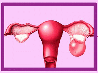 کیست تخمدان در زمان یائسگی ، از علائم تا علت