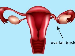 پیچ‌خوردگی تخمدان؛ علل و عواقب