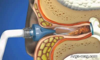 راهکارهای خارج کردن جرم گوش