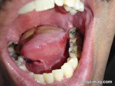 برای درمان زخم دهان چه روش هایی بهترین تاثیر را دارند؟