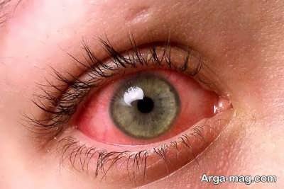 آشنایی با التهاب چشم