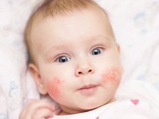 اگزما و آلرژیهای پوستی کودک