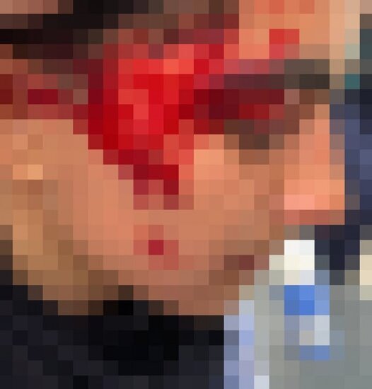 تصویری از پیشانی شکسته سپیده فلاحی بازیکن تیم پالایش گاز ایلام.