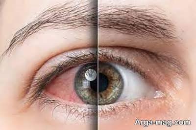 خشکی و التهاب چشم به دلیل کم خوابی