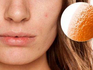 میزان اثرگذاری درمان پوست پرتقالی صورت با مزونیدلینگ