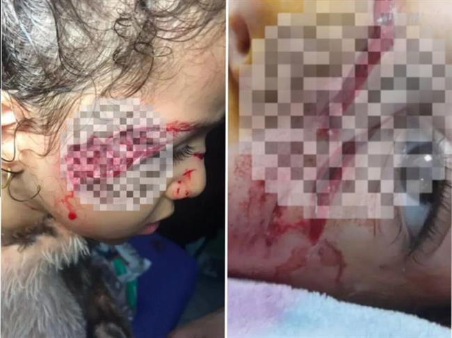 تصاویر دلخراش از حمله سگ‌های ولگرد ‌به دختر 5 ساله