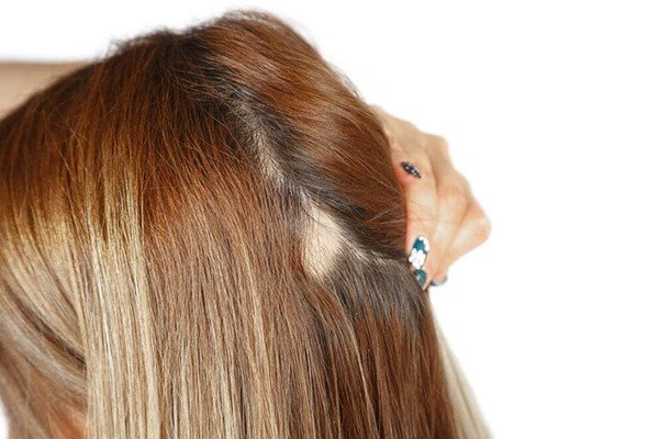 درمان قطعی ریزش موی سکه ای + بهترین روش های درمان 
