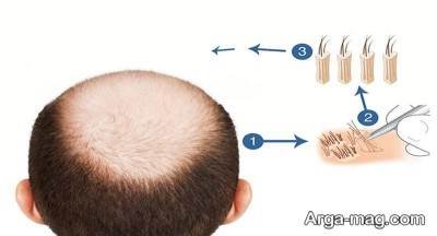 انواع روش های پیوند مو و بهترین سن برای کاشت مو