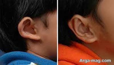 جراحی اتوپلاستی گوش چه عوارضی دارد؟ چه زمانی انجام دهیم؟