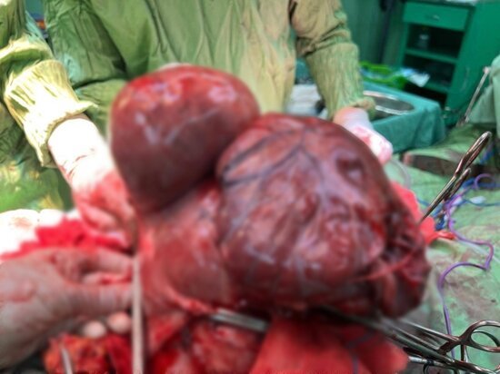 خارج کردن تومور 11 کیلویی از شکم بیمار در استان فارس/ عکس