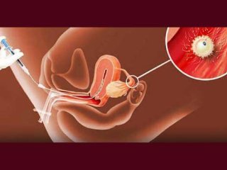 آشنایی با تلقیح داخل رحمی اسپرم مردان مبتلا به واریکوسل