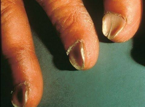 ظاهر ناخن‌ها خبر از چه بیماری‌هایی می‌دهند؟/ این 7 نشانه را جدی بگیرید