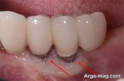 روش های پیشگیزی از بروز عفونت در ایمپلنت دندان