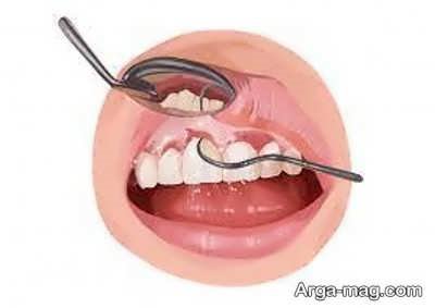 تاثیر سبک زندگی در بروز عفونت های ایمپلنت دندان