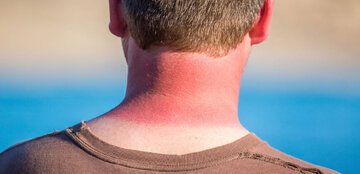 مراقبت از پوست در برابر آفتاب/تابستان را بدون آفتاب سوختگی بگذرانید