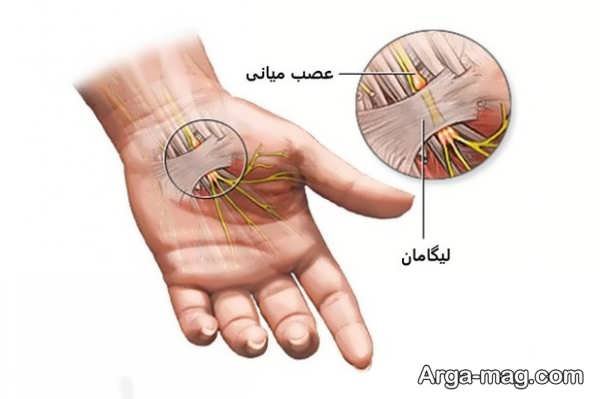 نشانه های سندرم تونل کارپال و چگونگی درمان آن