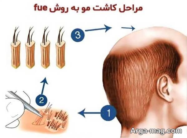 مراحل اجرای کاشت مو به روش fue