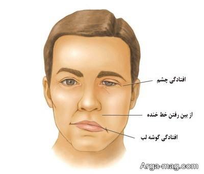 دلایل بروز و روش های درمان فلج بل + نشانه های این بیماری