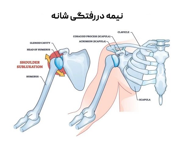 علائم نیمه دررفتگی شانه