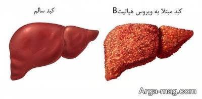 نحوه پیشگیری از هپاتیت b و شناخت علایم و راه های درمان آن