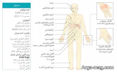 نشانه های سیروز کبدی برای تشخیص این بیماری