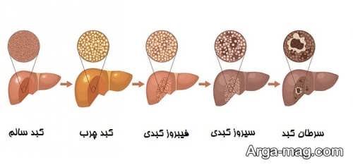 مرور علائم سیروز کبدی و دلایل ابتلا به این بیماری