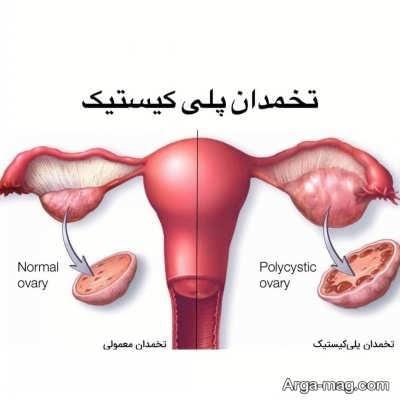 درمان سندرم تخمدان پلی کیستیک