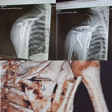 انجام عمل جراحی ترمیم شکستگی همزمان استخوان های ترقوه و اسکاپولا در مرکز درمانی کوثر سنندج