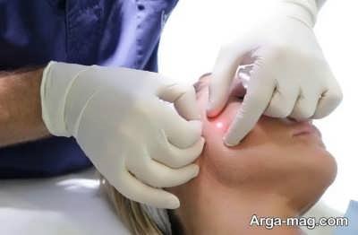 بررسی کاربرد اندولیفت و مزایای این روش
